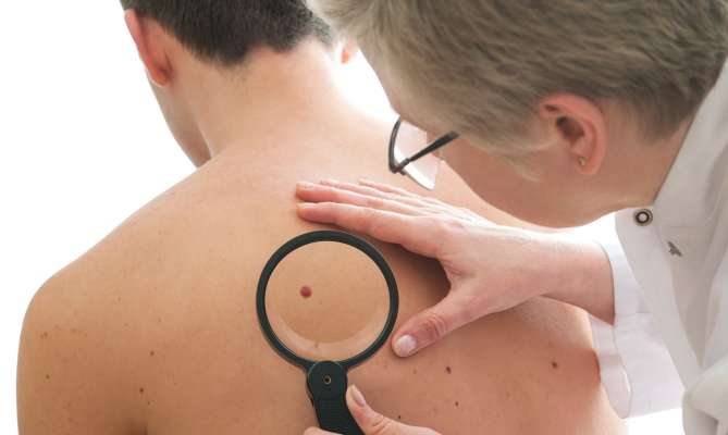 Doctor examines a mole on a person's back with a magnifying glass.